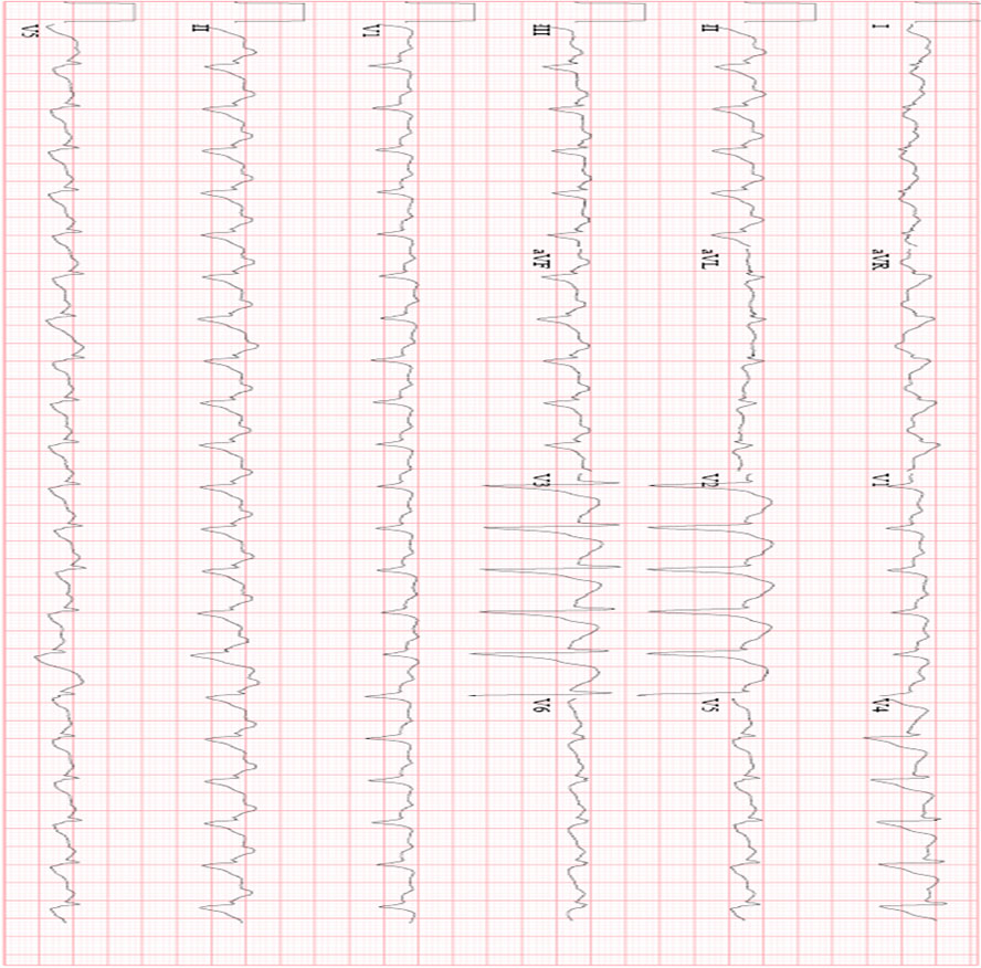 Tca Ecg